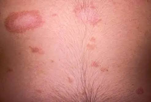 Topical Steroids for Pityriasis Rosea